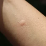 utslag på kroppen som inte kliar