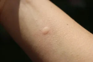 utslag på kroppen som inte kliar